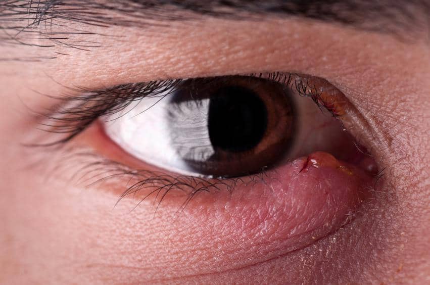 pmus-eye-with-stye-infection